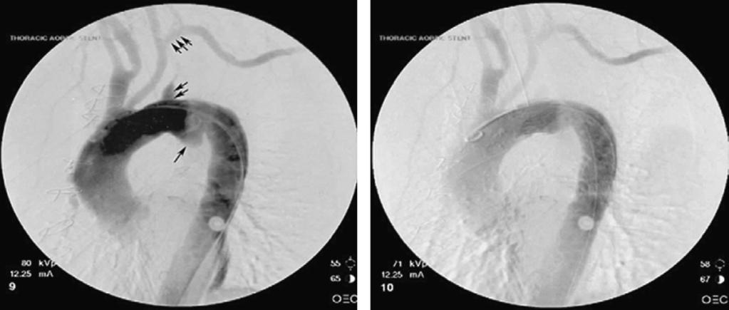 456 Nicolaou et al Fig. 3. Aortic angiograms. (Left) A prerepair angiogram after LSCA to carotid transfer.