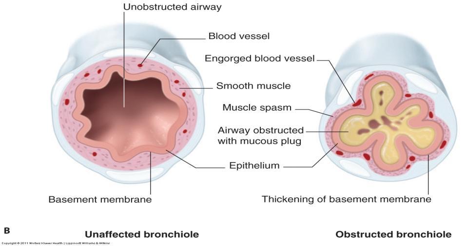 Bronchial hyperresponsiveness (IgE mediators cause edema,