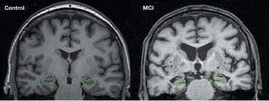 Figure 13. Comparable T1-weighted Coronal MRI Imaging of Control and MCI Medial Temporal Structures (Ballard et al., 2011).