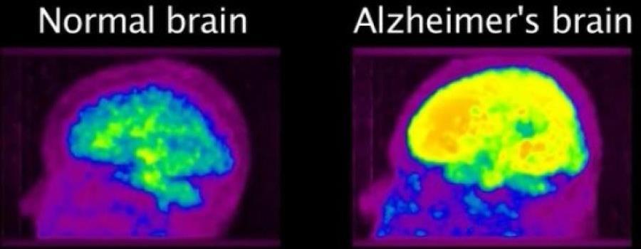 Figure 15. PiB PET scan comparing brains of people with and without Alzheimer's disease. Yellow color indicating amyloid positivity.