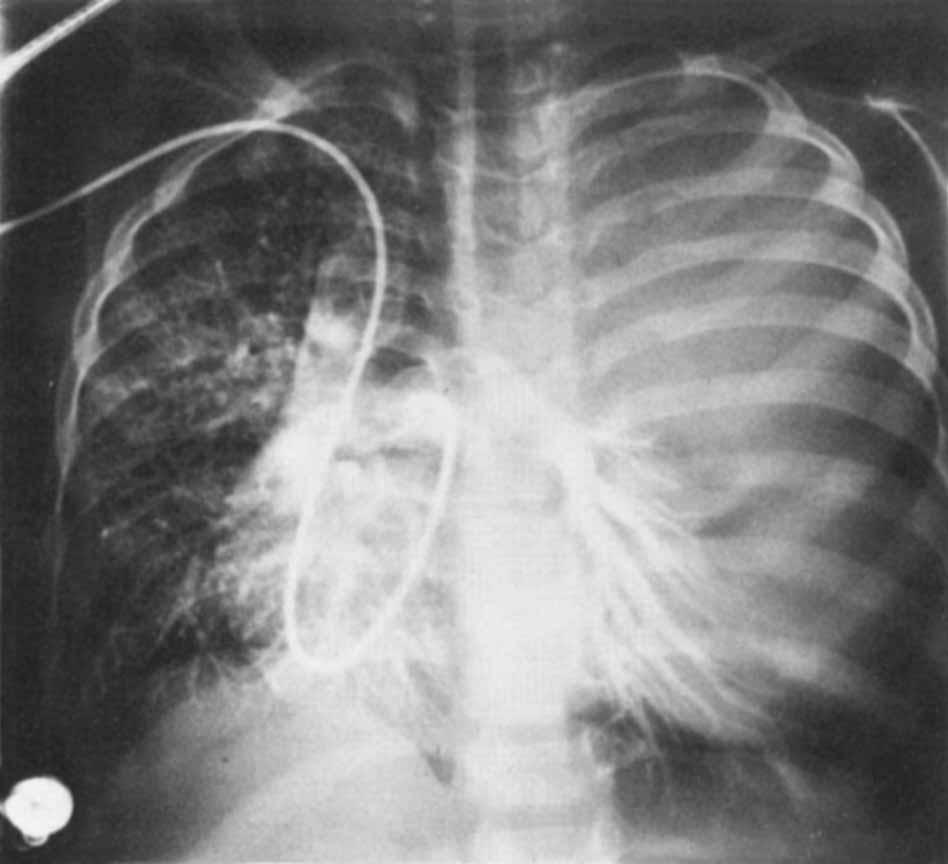 (SN = suprasternal notch, X = Xiphoid) detected in the expected location. The appearance of this lesion was considered to be consistent with a cystic hygroma or cystic teratoma. An angiogram (Fig.