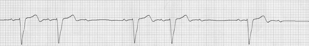 Mobitz II Block occurring in His-Purkinje System Usually wide QRS (Purkinje
