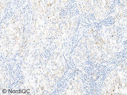 6b, same protocol. Fig. 6b Insufficient PD-L1 staining result of the NSCLC tissue core no. 16 using same protocol as in Fig. 6a.