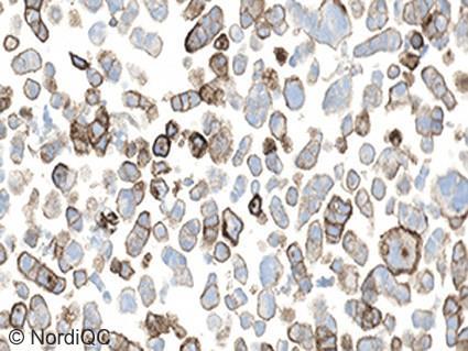 The assay has not been calibrated to demonstrate the weak PD-L1 expression in the tumour cells.