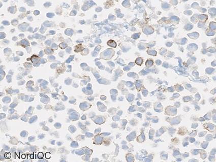 Fig. 8a Optimal PD-L1 staining result of the cell line (Horizon Discovery) core no. 3 using the pharmdx IHC PD-L1 assay, SK006, Dako/Agilent based on the mab clone 22C3.