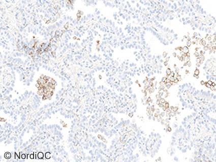 Fig. 2a Optimal PD-L1 staining result of the NSCLC tissue core no. 14 using same protocol as in Fig. 1a.