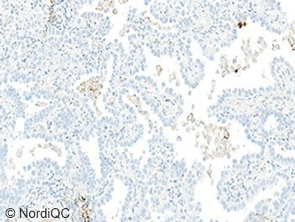 control. The tumour is categorized as TPS negative. Fig. 2b PD-L1 staining result of the NSCLC tissue core no. 14 using same protocol as in Fig. 1b.