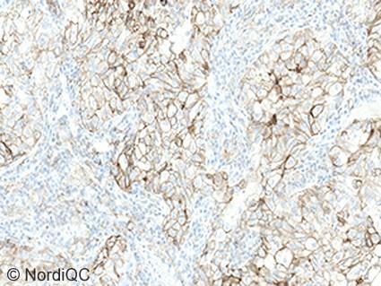 However also compare with Figs. 3 5b Fig. 3a Optimal PD-L1 staining result of the NSCLC tissue core no. 11 using same protocol as in Figs. 1a and 2a.