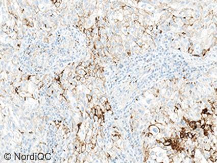 The tumour is categorized as TPS high and thus eligible for 1 line immune therapy. Fig. 3b PD-L1 staining result of the NSCLC tissue core no.