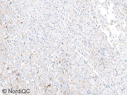 The tumour is categorized as TPS high and thus eligible for 1 line immune therapy. Fig. 4b Insufficient PD-L1 staining result of the NSCLC tissue core no. 6 using same protocol as in Figs. 1b - 3b.