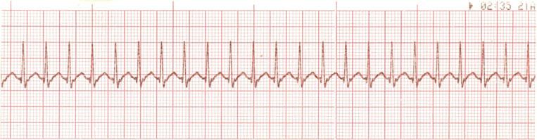 3) Nodal (or AV junctional) tachycardia may superficially resemble atrial tachycardia because the P wave is buried in the T waves of the preceding beat and becomes invisible, but the rate of nodal