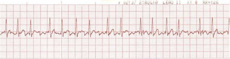 0) is started and cardioversion is delayed for 2 to 3 weeks. After conversion to sinus rhythm, anticoagulation is continued for an additional 3 to 4 weeks.
