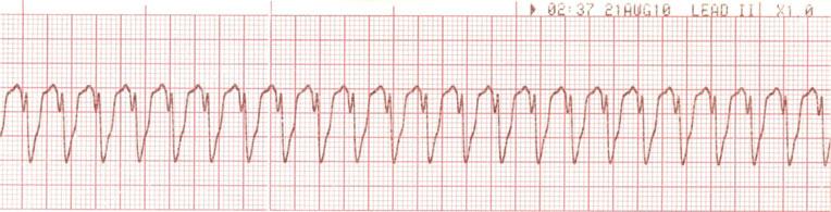 Fig. 5 Electrocardiogram showing ventricular tachycardia result from toxicity with type IA antiarrhythmics (e.g., procainamide, quinidine, and disopyramide) or type III antiarrhythmics (e.g., sotalol and amiodarone), tricyclic antidepressants, digitalis, or drug interactions [8].