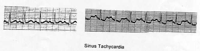 Treatment: Sinus Tachycardia Alleviate the underlying cause-anemia, anemia, pheo,