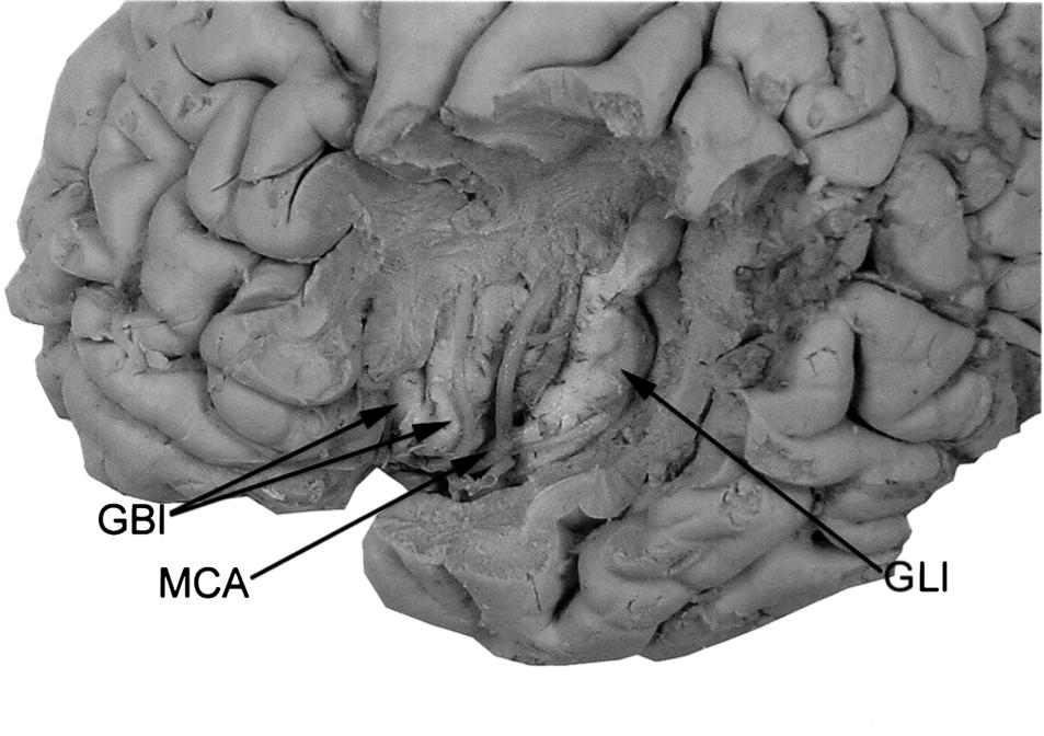 30 Maley Fig. 12. Lateral surface of the cerebral cortex. The frontal operculum, parietal operculum, and temporal operculum have been removed to reveal the deeply located insula in the lateral sulcus.