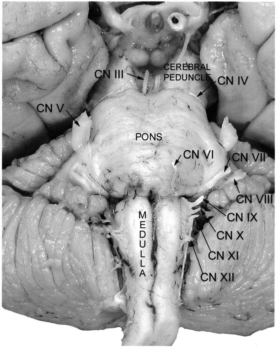 26 Maley Fig. 6. Posterior surface of the brainstem, demonstrating the rhomboid. The rhomboid fossa (outlined by dashed lines) is visible after removal of the cerebellum.