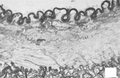 Classic Papers in Coronary Angioplasty (a) (b) Figure 1 Light micrographs demonstrating (a) a normal primate iliac artery (Mecaca nemestrina) ( 550); (b) an iliac artery 3 months after