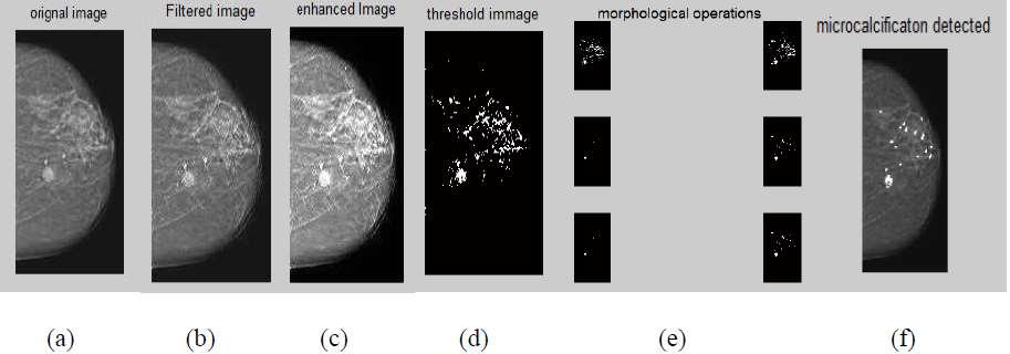 Figure 5. Result: (a) Original Image (b)filtered Image (c) Enhanced Image (d) Image After Automatic Thresholding (e) Image After Post-processing (f) Image with Microcalcification Detection Figure 6.