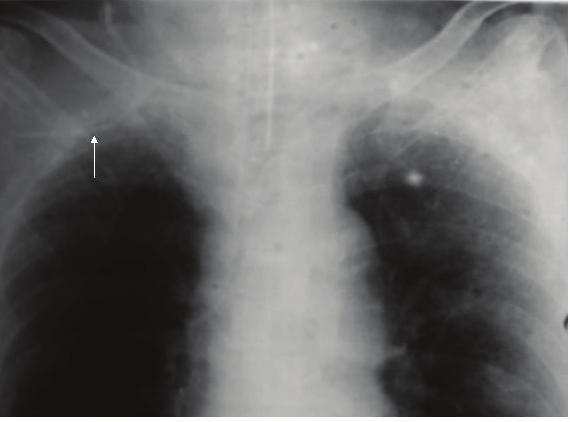 CATHETER MALPOSITION FOLLOWING SUPRACLAVICULAR APPROACH FOR SUBCLAVIAN