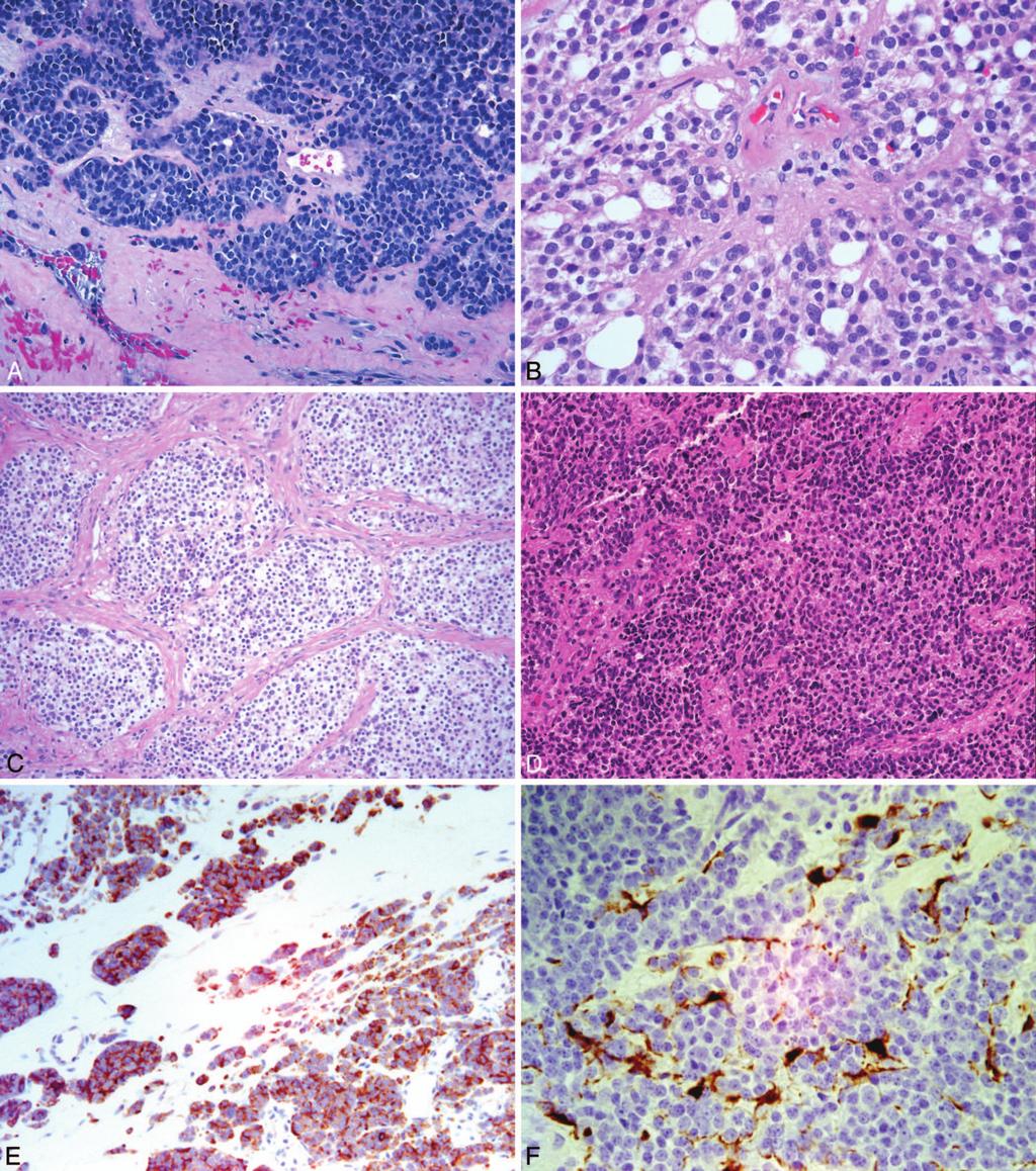 Figure 2. Olfactory neuroblastoma (ONB). A, Examination shows a cellular small round cell tumor with a nested appearance.