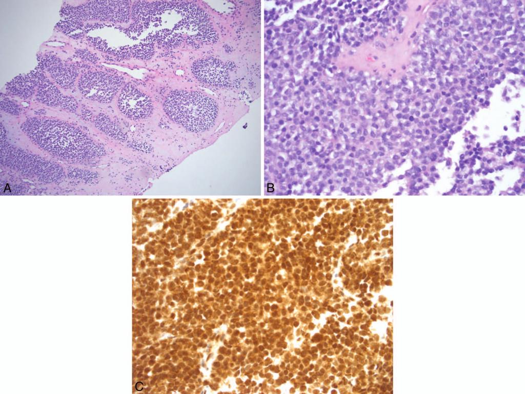Figure 4. Ewing family of tumors. A, Low-power view of a core biopsy of a maxillary sinus mass in a 16-year-old adolescent boy, showing nests of small round blue cells.