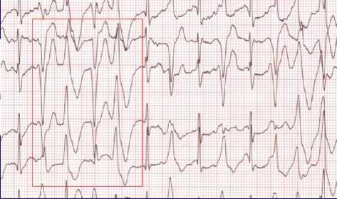 Catecholaminergic Polymorphic Ventricular Tachycardia (CPVT) Arrhythmic manifestations PVCs, Bidirectional VT Onset of VAs with physical exercise, emotional stress, or catecholamine administration,