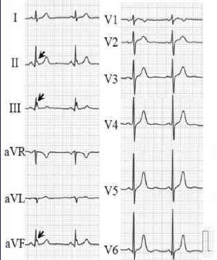 Am J Cardiol 2012;110:615-620 Presence of early repolarization on