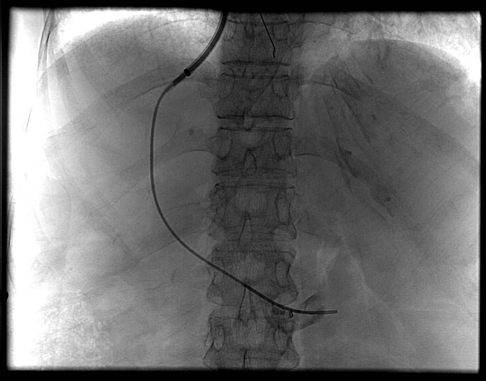 Catheter in Portal Vein