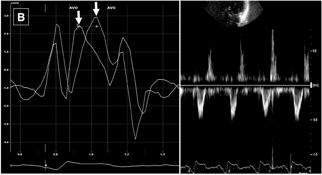 An example of patient with optimal V-V interval of LV60.