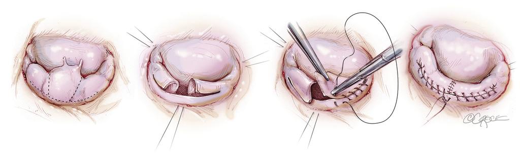 Figure 2 Foldoplasty involves placing a simple stitch in the leading edge of the prolapsed posterior segment, which is brought back underneath the segment to the annulus and tied there.
