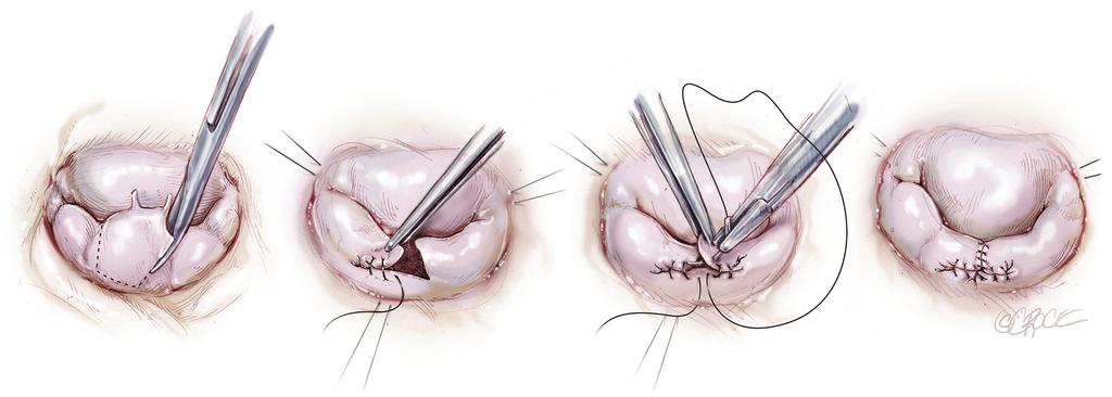 Similarly, valve damage in the area of the commissures can simply be repaired by a commissuroplasty, which obliterates this part of the valve with mattress sutures rather than resecting and