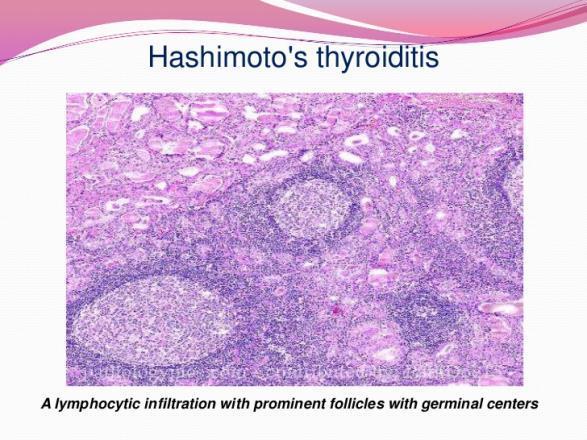 Etiology of Acquired Hypothyroidism Hashimotos Thyroiditis: Antiperoxidase antibody (TPO Ab) 85-90% positive Antithyroglobulin antibody (Tg Ab) 30-50% positive