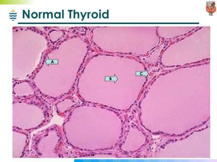 com/cpc-4-3-1-end-thyroid-pathlec-view-100707014056- phpapp02/95/pathology-of-thyroid-endocrine-disorders-25-728.jpg?cb=1278467411 https://www.google.com/search?