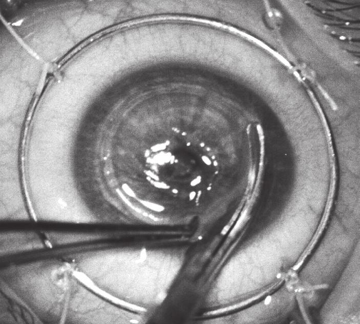 PART IX Section 2 KERATOPLASTY Procedures 1340 Fig. 114.7 Cutting host cornea with corneal scissors. perpendicular during trephination the initial opening will usually be less than one clock hour.