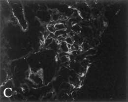 Immunofluorescence Tissue sections were stained with antibodies to C3d (DakoCytomation, Carpinteria, CA, USA), C4d (Quidel Corporation, Santa Clara, CA, USA), and C8 (Quidel Corporation).