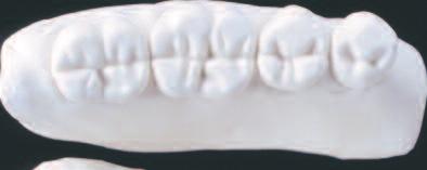 during lateral movements through plane occlusal design Ã Appealing aesthetic appearance
