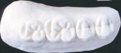 the premolars Ã A tooth especially designed for geroprosthodontics Set-up of the SR