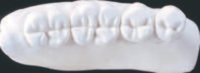 First and second molars All cusps come into plane contact with the template.