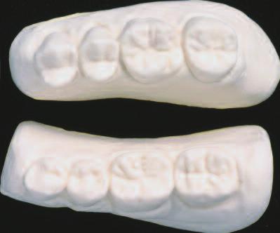 Fully anatomical occlusion Teeth with a true-to-nature occlusal relief, such as SR Postaris DCL, intend to enable an intercuspation that is similar to that of the natural occlusion and permit the