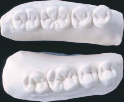 Lingualized occlusion Teeth which have been designed for lingualized occlusion, such as SR Ortholingual DCL, are distinguished for a more dominant palatal cusp in the maxilla and a functional central