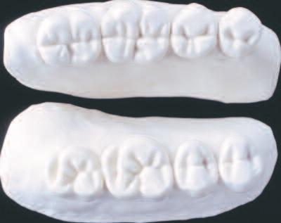 In this way, the buccal masticatory forces, which are unfavourable for the dentures, can be reduced and the dentures are optimally stabilized on the denture bearing area by the masticatory forces