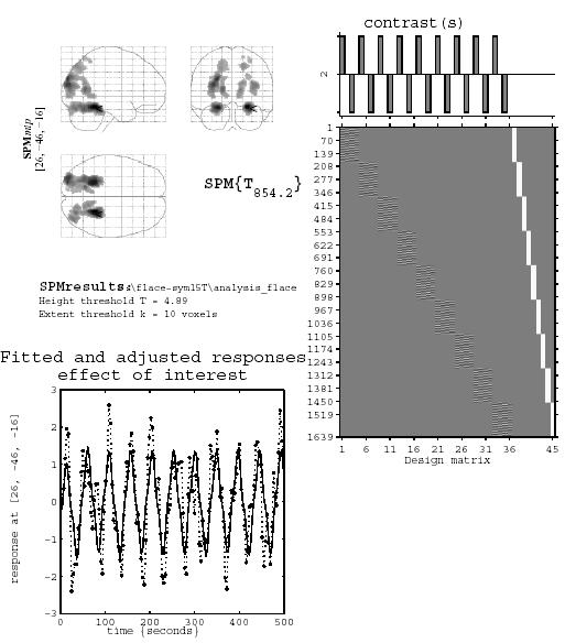 Fig. 4.6: Example output of the statistical analysis using a widely used program SPM. On the top left the areas of significant activation are shown, with the red arrow indicating the selected voxel.