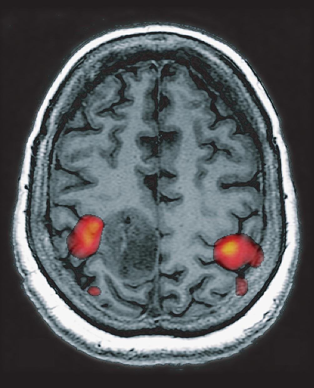 fmri of Brain Tumours R L Figure 1.