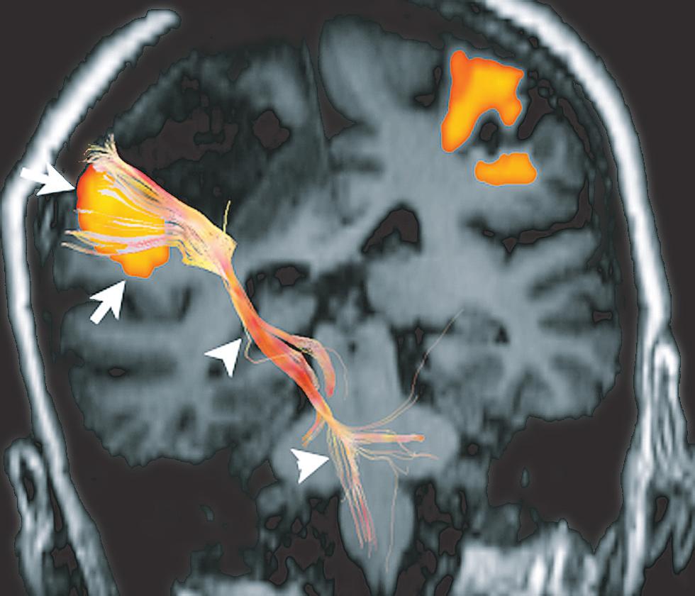 plete resection could be achieved safely when the distance between fmri activation and tumour margin exceeds 1 cm [42].