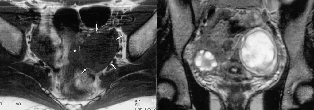 MR-Pathologic Correlation in Sclerosing Stromal Tumor of Ovary A 