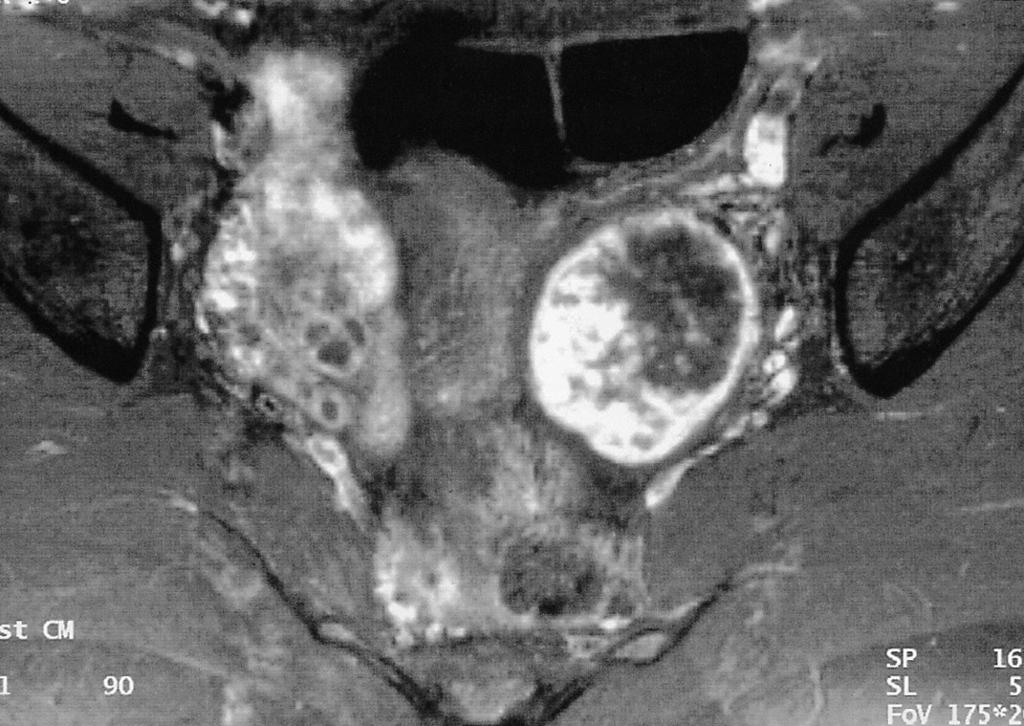 Axial T1-weighted MR image demonstrates a round, left adnexal mass (arrows), with a slightly hyperintense peripheral portion relative to muscle and a homogeneous central hypointense area. B.