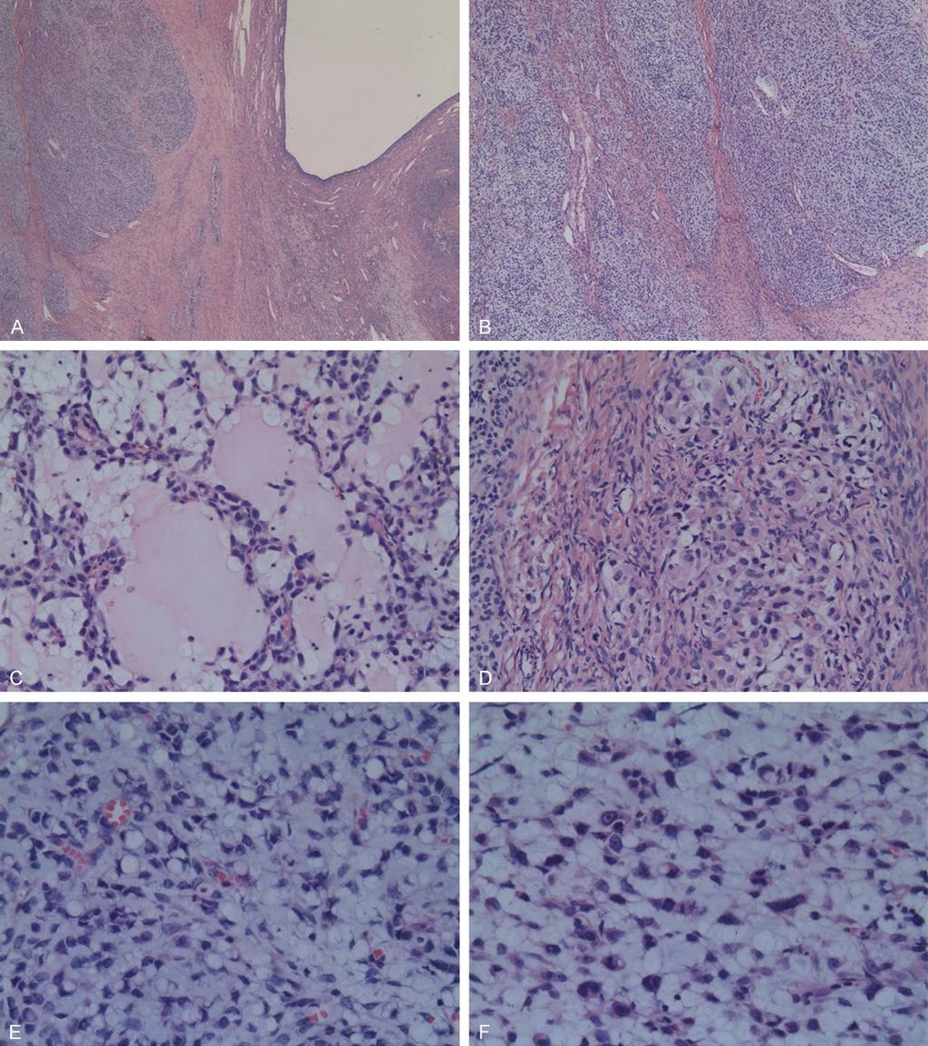 Figure 1. Well demarcated contoured mass with the background ovarian parenchyma (A). The prominent solid cellular areas inserted by thick fibrous hyaline stroma (B).