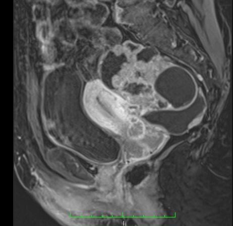 following the normal flow pa^ern of peritoneal circulafon Certain sites are favored due to