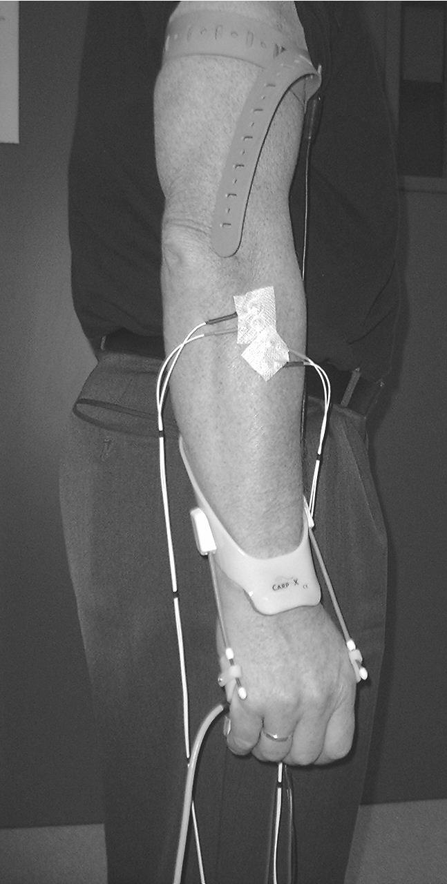 Hand-grip dynamometer EMGelectrodes Dynamic extensor brace FIGURE 3. Position of the arm during the gripping test with the dynamic extensor brace with the wrist in neutral position.