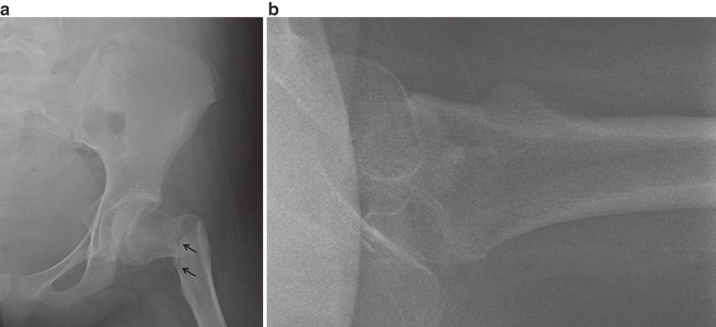 2 Radiologic Evaluation of Femur Fractures 39 Fig. 2.15 (a) AP radiograph of the left hip in a 12-yearold female demonstrates a fracture through the cervicotrochanteric portion of the femoral neck.